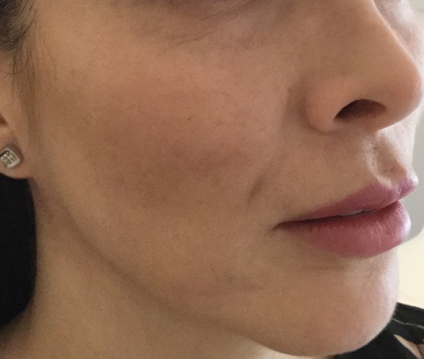 Melasma - Después del tratamiento